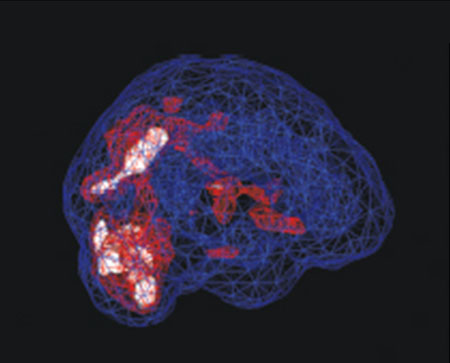 Why SPECT | The Science | Amen Clinics Amen Clinics
