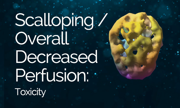 Scalloping / Overall Decreased Perfusion: Toxicity