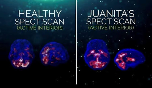 Juanita spect scan