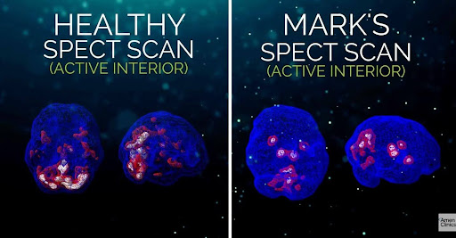 spect scan - mental breakdown