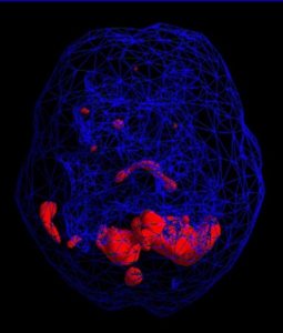 healthy brain SPECT scan