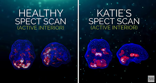 healthy spect scan and katie spect scan