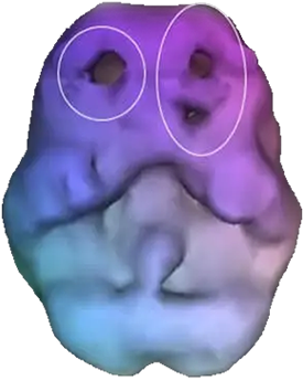ADHD SPECT scan