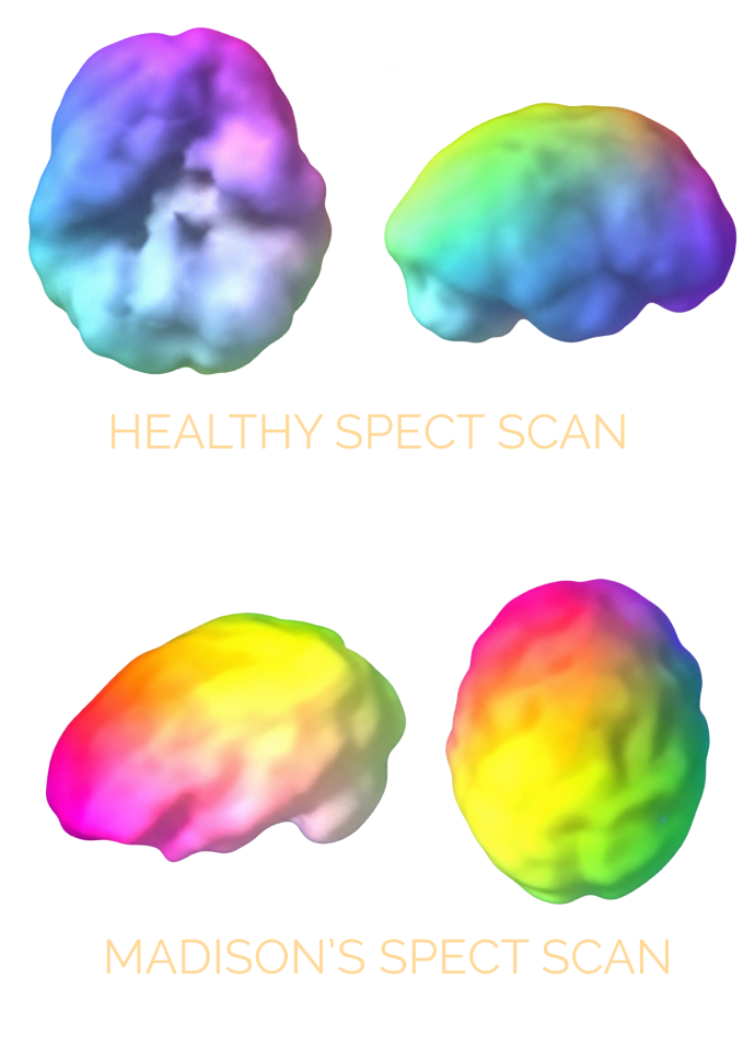 Healthy SPECT scan compared to Madison's SPECT scan, surface view