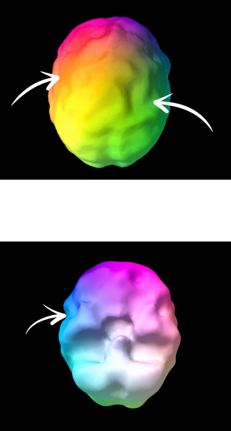 Madison's SPECT scan showing scalloping and areas of underactivity