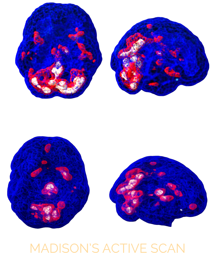 Madison's active SPECT scan