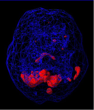 Healthy active brain SPECT scan showing full, even activity with increased cerebellar activity