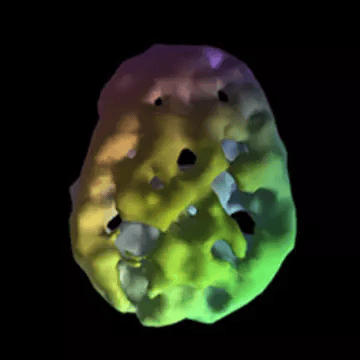 Brain SPECT scan showing scalloped, pitted surface activity associated with heavy alcohol use