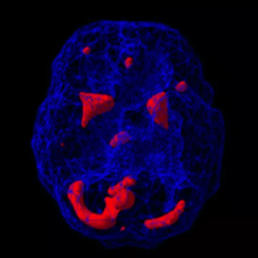 Brain SPECT scan showing increased activity in multiple regions associated with anxiety